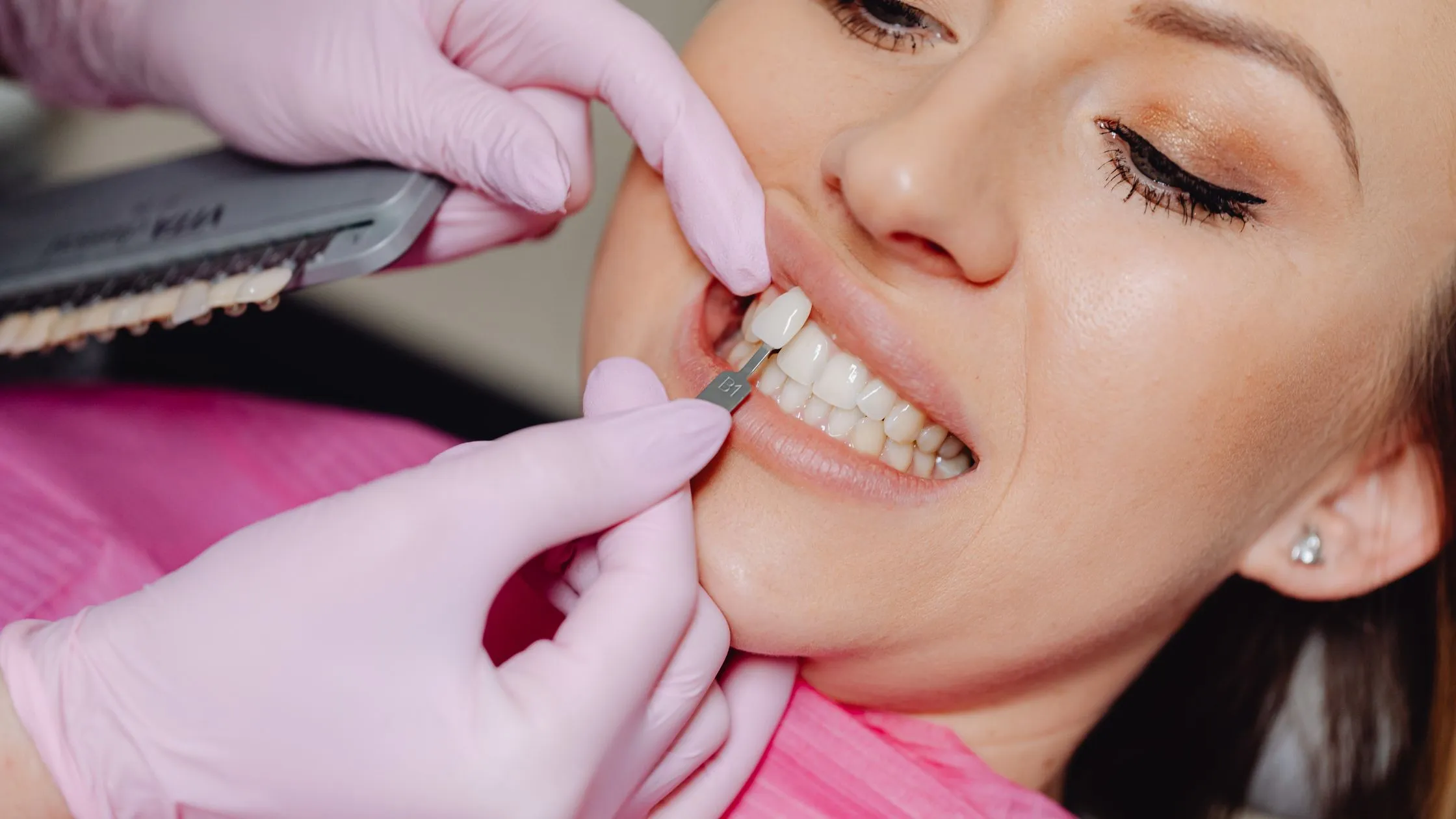 How Does Teeth Prepped for Veneers Works