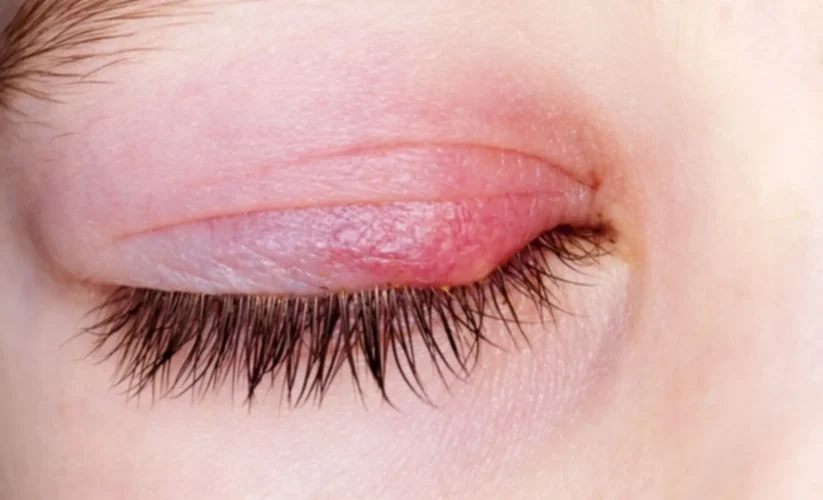 Commonly Misdiagnosed Conditions Mistaken for Pink Eye