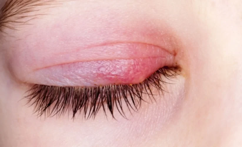 What Is Commonly Misdiagnosed As Pink Eye