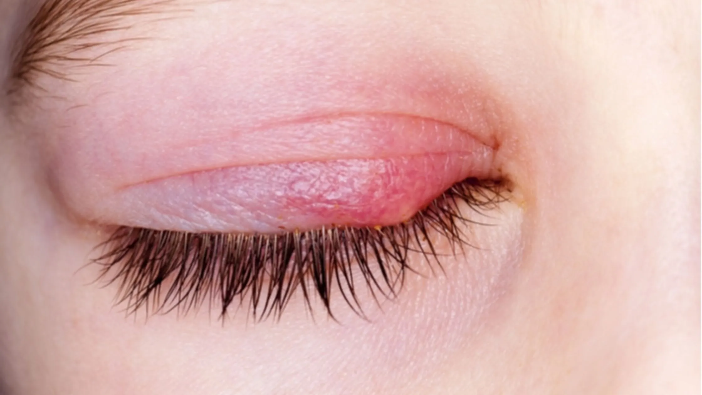 Commonly Misdiagnosed Conditions Mistaken for Pink Eye