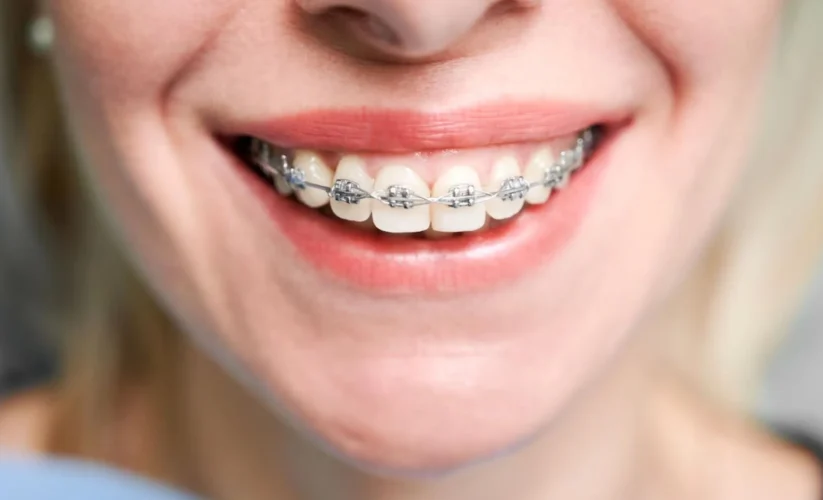 How Long Does It Take To Get Braces?